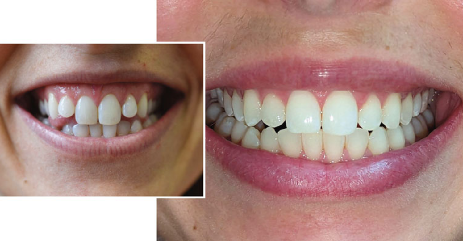Myotonic Dystrophy and Oral Health 2